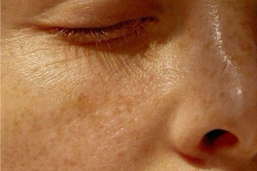 The Gut-Skin Connection: How Gut Health Impacts Rosacea and Acne