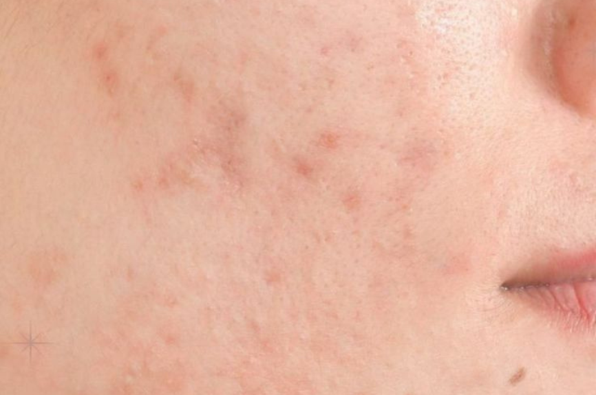 Lupus or Rosacea?