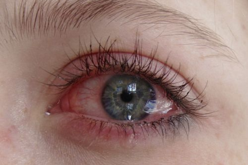 Different Types of Rosacea: Subtype four - Ocular Rosacea