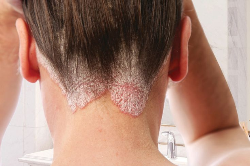 Rosacea or Psoriasis & How to Tell Them Apart
