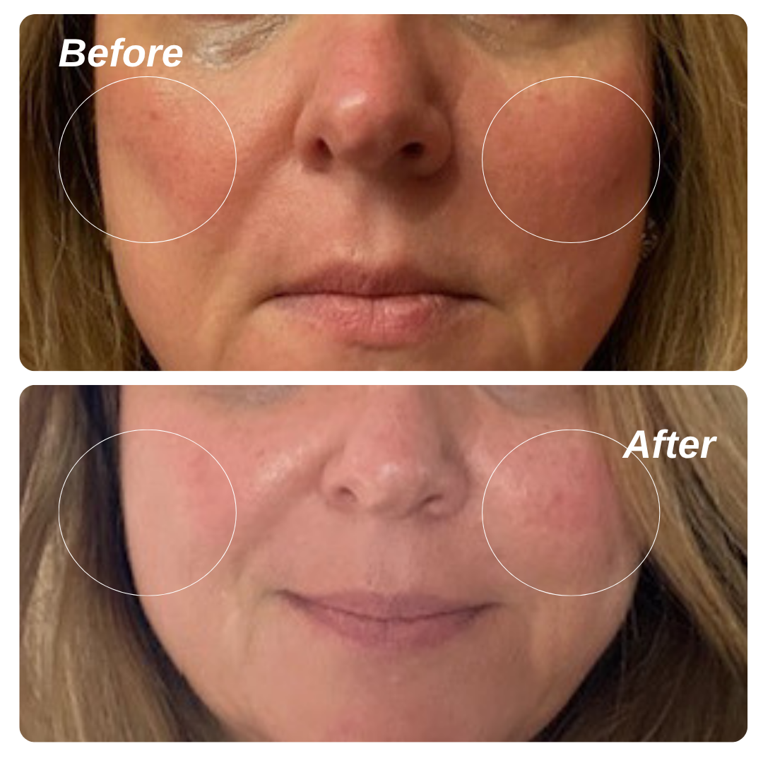 5% Vita C + Ceramides for Sensitive Skin