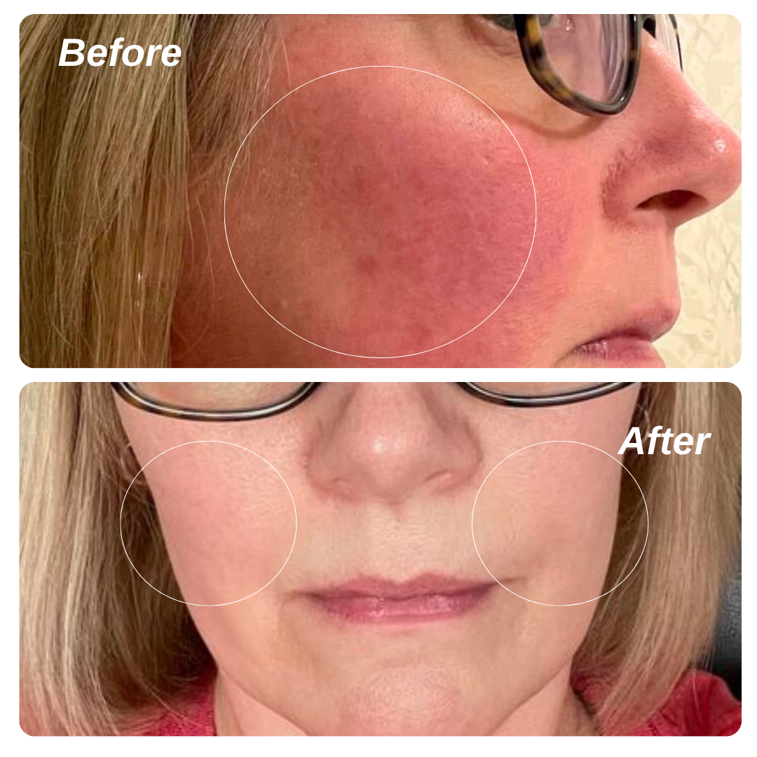 Ruddi Redness Control 1.7oz (50ml)