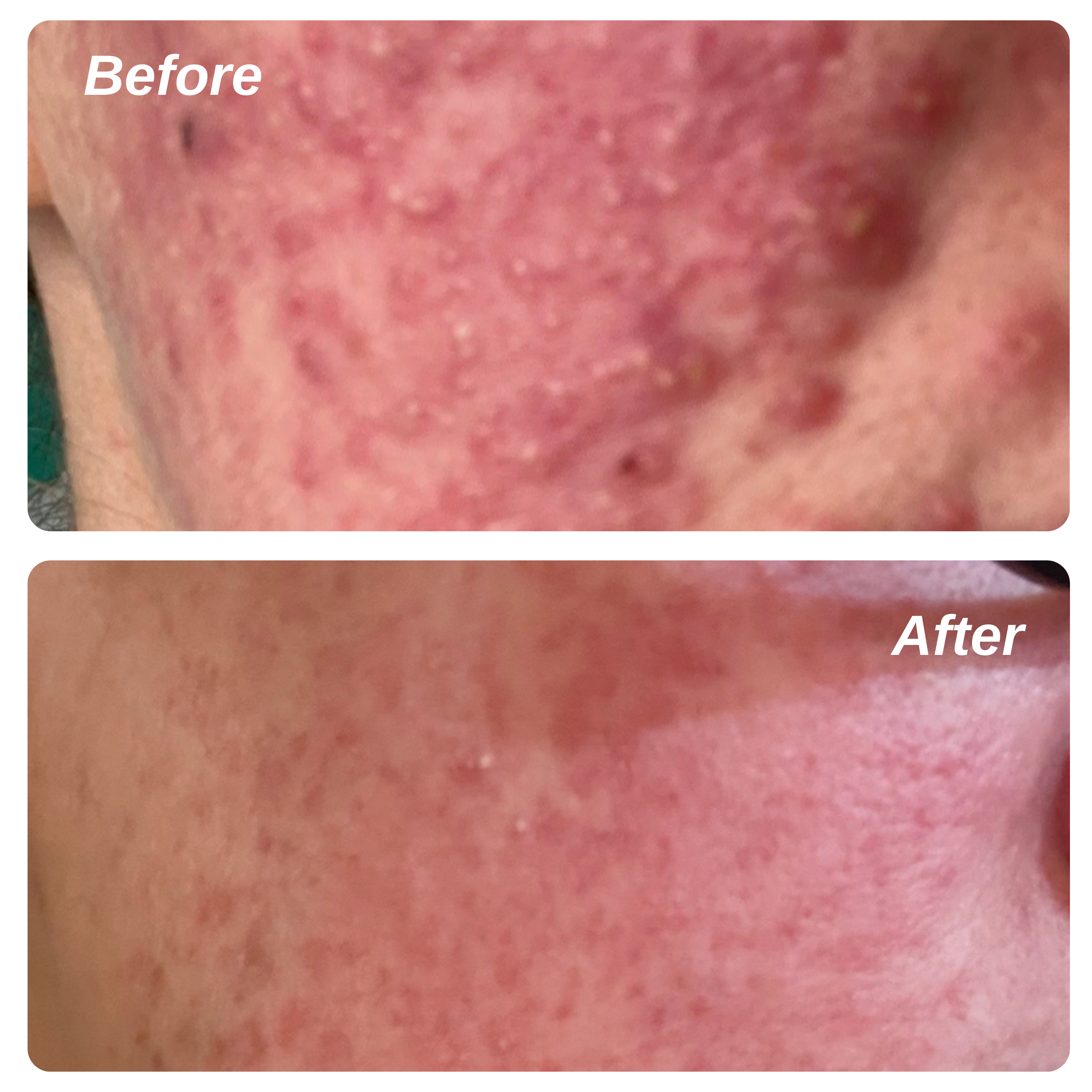 10% Azelaic Acid Redness Calming Cream