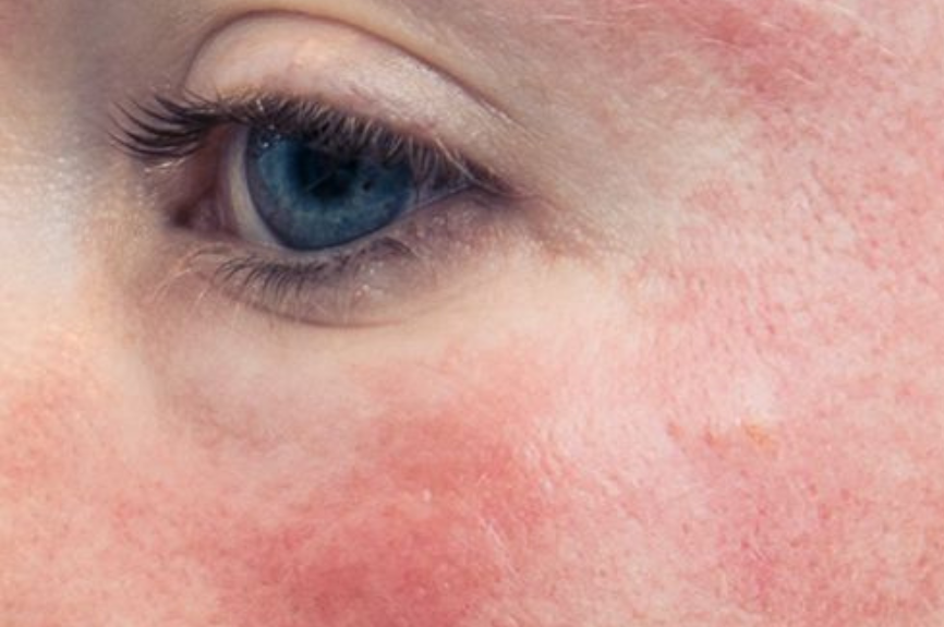 What Causes Rosacea? A Deep Dive into the Science Behind the Redness