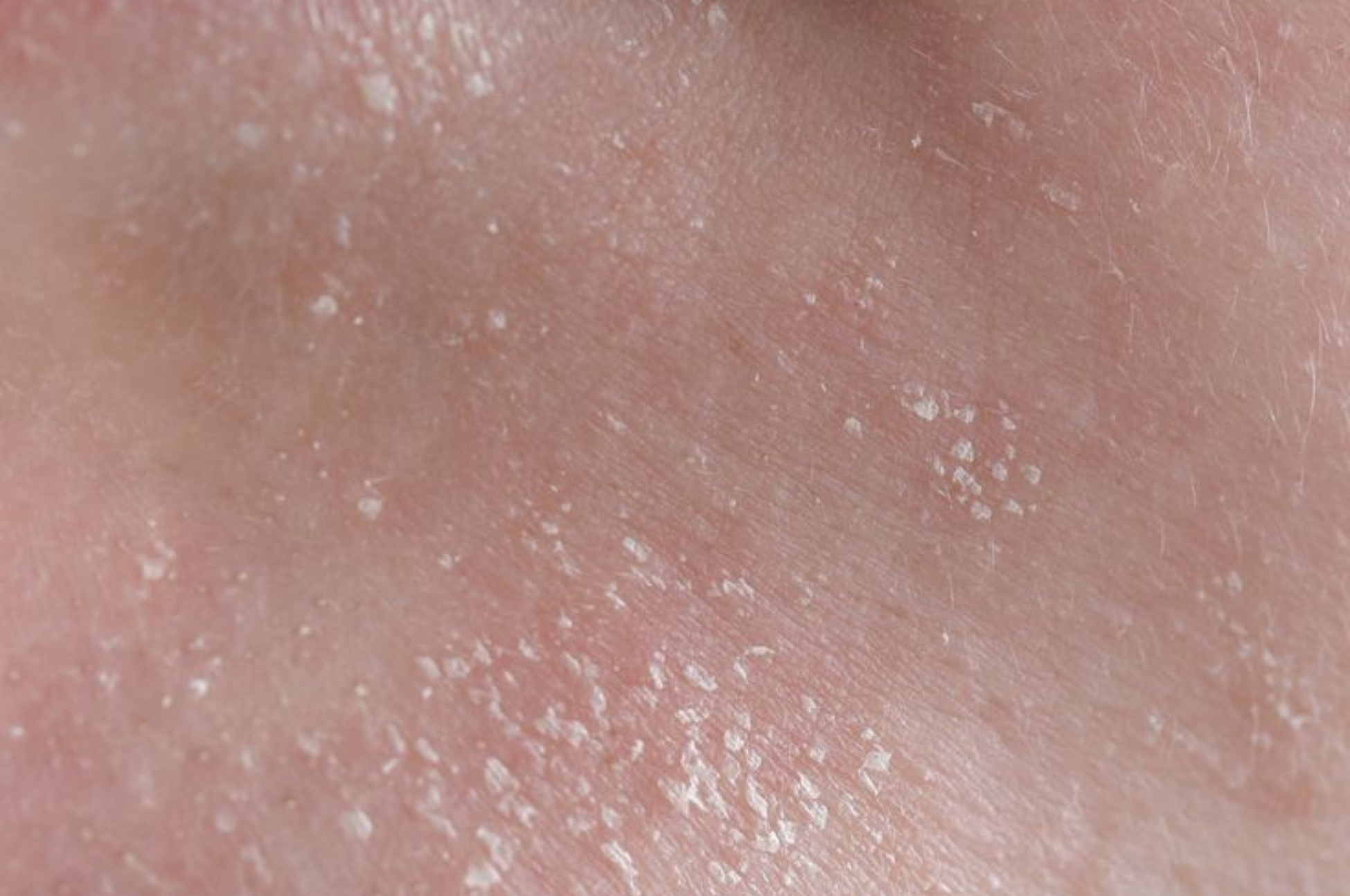 Dry Skin vs. Dehydrated Skin: What’s the Difference