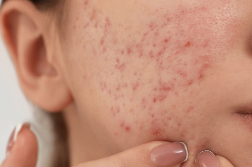 Inflammation, Hormones &amp; Bacteria: The Science Behind Breakouts