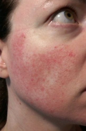 Can you get rid of Rosacea permanently?