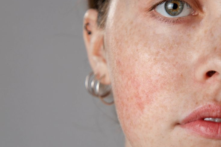 Can you get rid of Rosacea permanently?