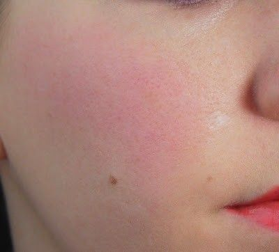 Rosacea Subtype 1: Everything you need to know