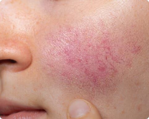Rosacea or Psoriasis? How to Tell Them Apart