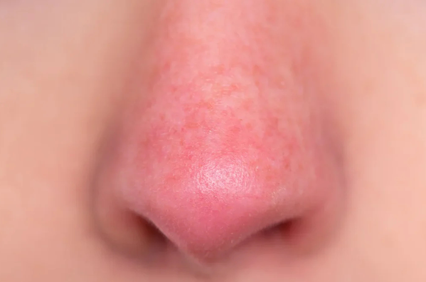 Different Types of Rosacea:  Subtype three - Rhinophyma