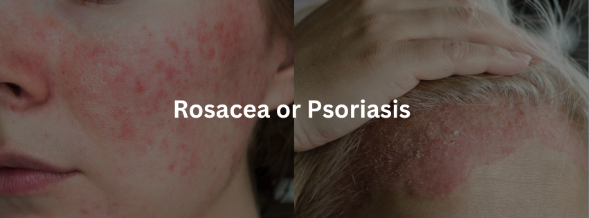 Rosacea or Psoriasis & How to Tell Them Apart