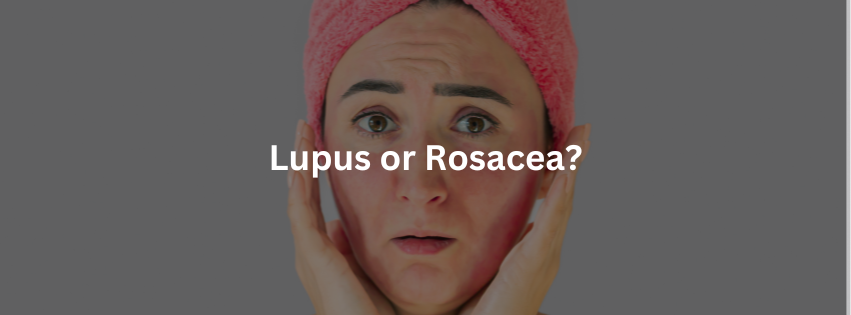 Lupus or Rosacea?