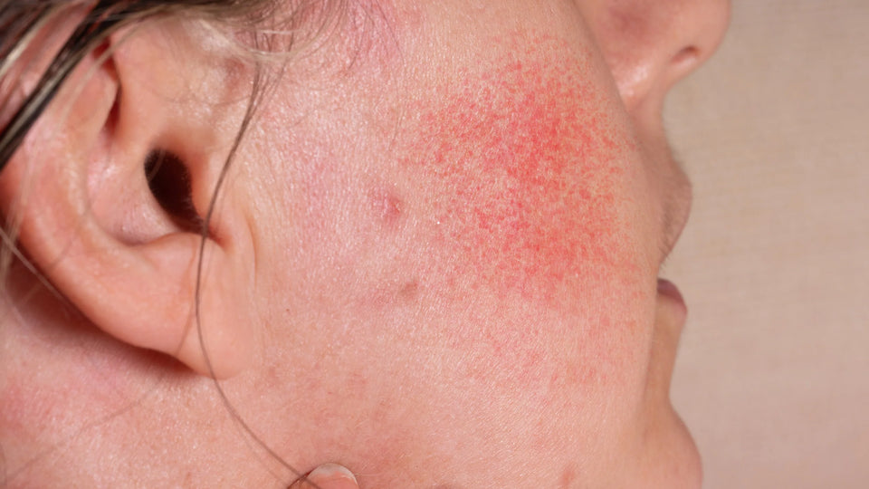 Ivermectin for Rosacea: What is it, how does it work & how long should I use it?