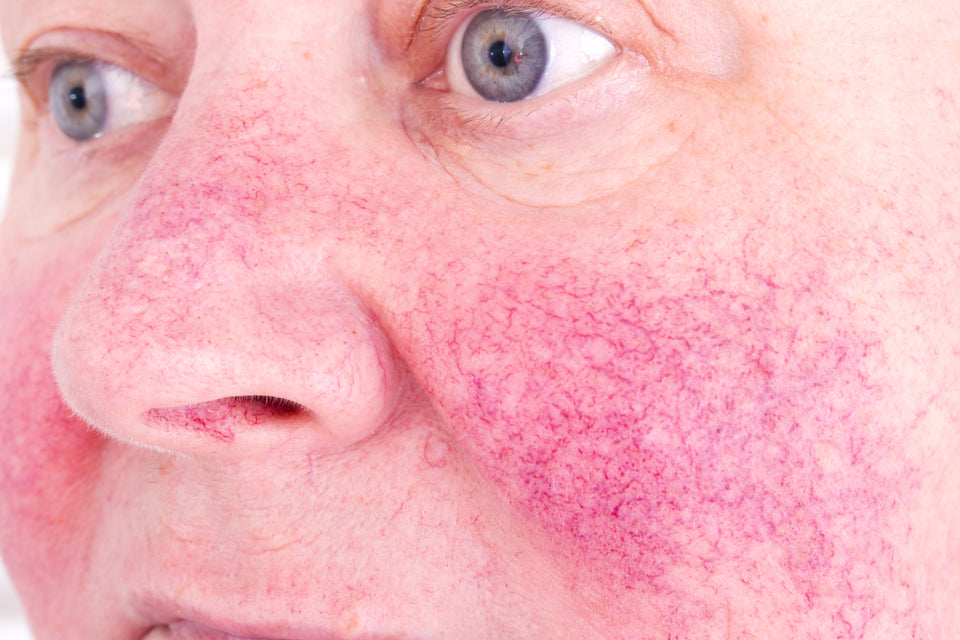 The Ultimate Guide to Azelaic Acid for Rosacea Relief