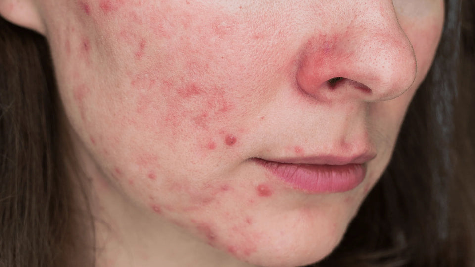 Different Types of Rosacea:  Subtype two -papulopustular (or acne) rosacea