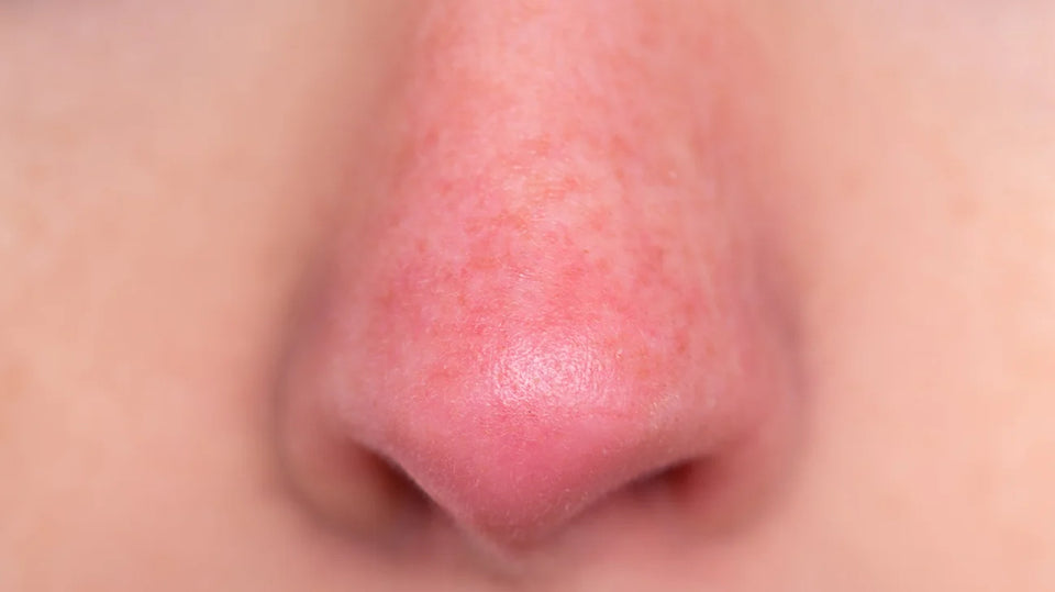 Different Types of Rosacea:  Subtype three - Rhinophyma