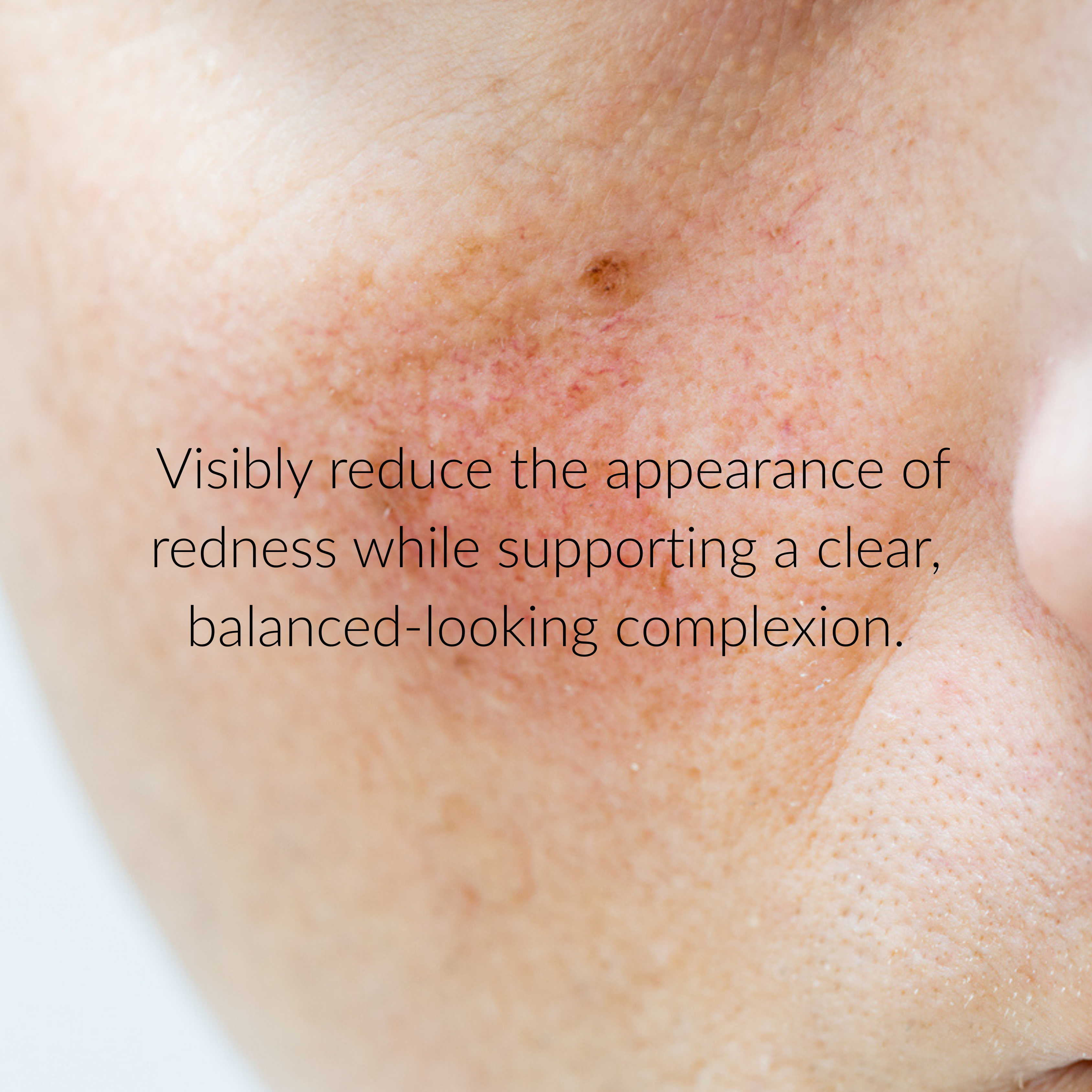 10% Azelaic Acid Redness Calming Cream