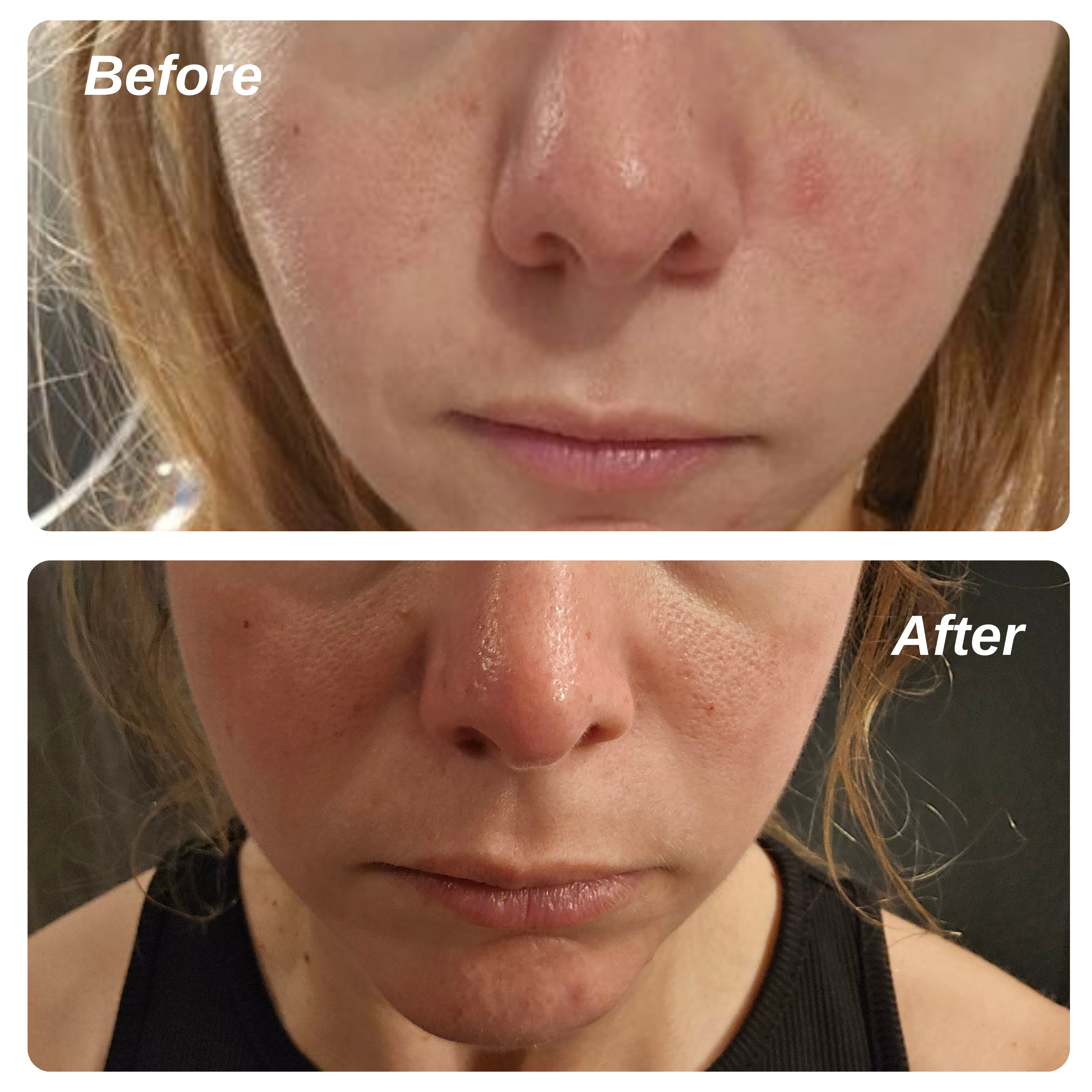 10% Azelaic Acid Redness Calming Cream